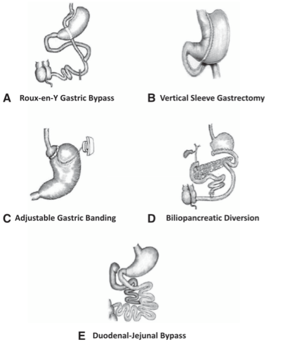 Illustrations of four types of bariatric surgery: a) roux-en-y gastric bypass, b) vertical sleeve gastrectomy, c) adjustable gastric banding, d) biliopancreatic diversion.