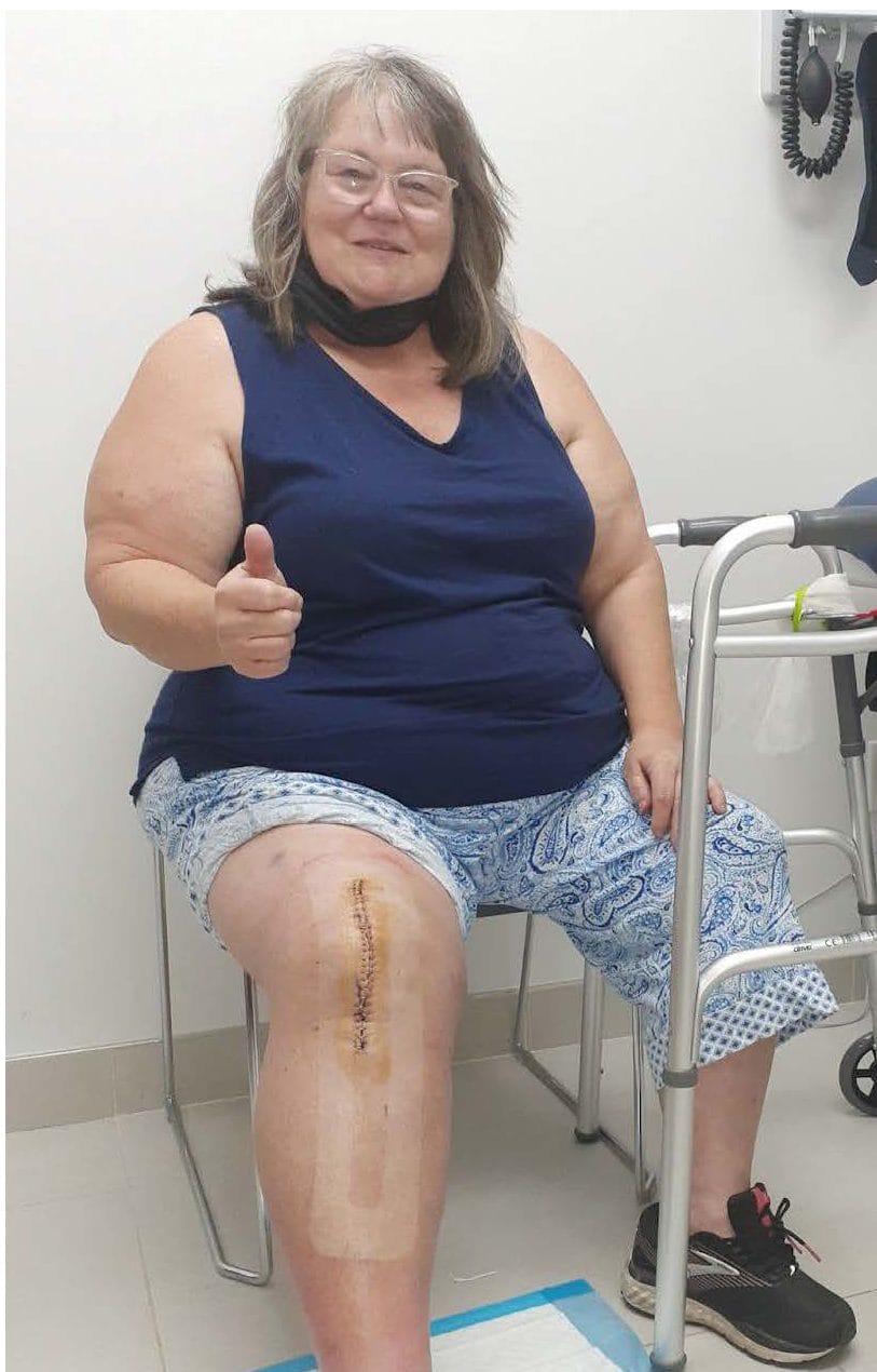 Woman sitting in a medical office, giving a thumbs-up, with a visible surgical scar on her knee.